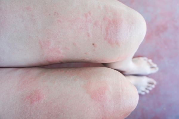 atopowe zapalenie skóry alergie