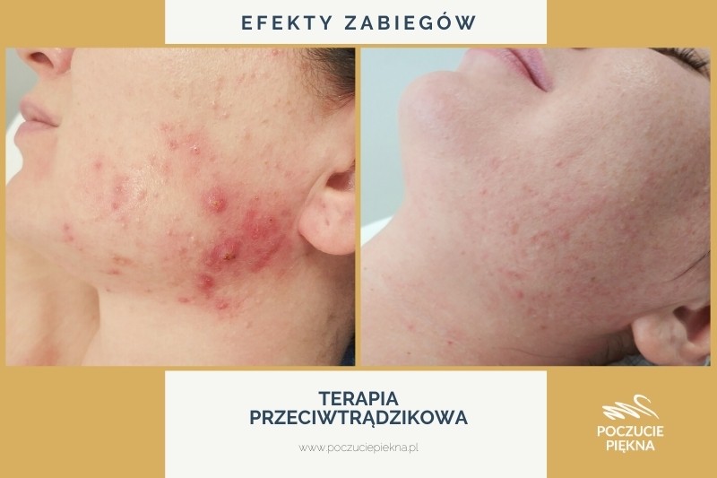 terapia przeciwtrądzikowa Wrocław Poczucie Piękna - efekty