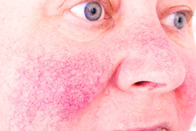 leczenie trądziku różowatego zabiegami w salonie kosmetycznym